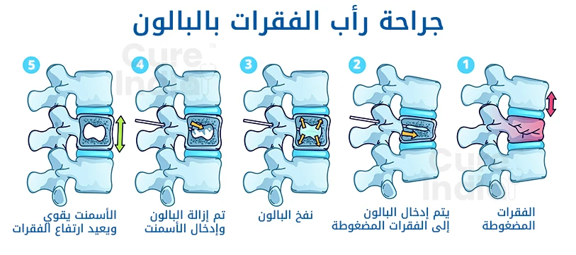 غرض جراحة رأب الفقرات بالبالون